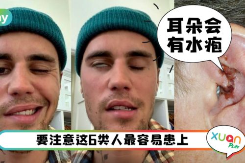 健康｜翻白眼、嘴巴合不拢，Justin Bieber患这罕见带状孢疹并发症！