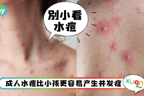 健康｜别小看成人水痘！病情更严重、怀孕发病还会影响胎儿！