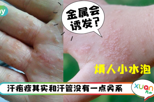 健康｜手脚偶尔冒出小水泡，原来压力大、HIV感染者都会有汗疱疹！