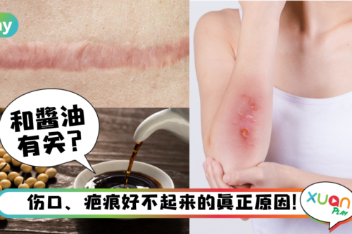 Tips｜有伤口不能吃海鲜蘑菇？吃酱油真的会留疤？