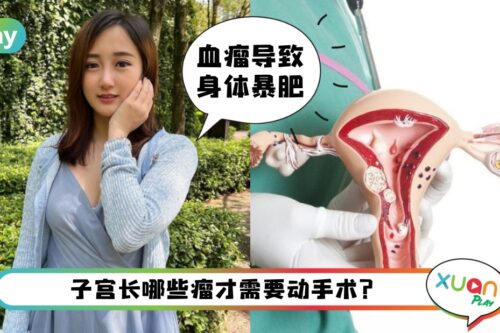 健康 I 什么是肌瘤、血瘤和水瘤？子宫长这些需要动手术吗？