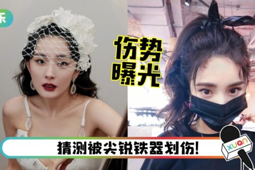 出动专家治疗！杨幂伤势曝光 用美容针缝合伤口