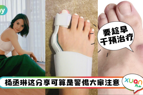 健康｜杨丞琳脚拇趾外翻吓坏人，太严重还必须动手术？