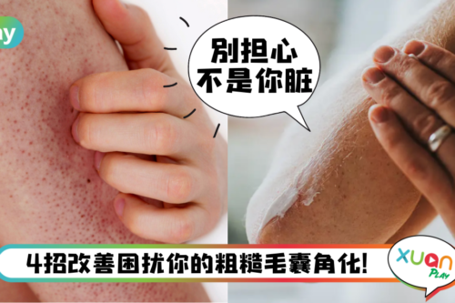 Tips｜胸前、手臂长粗粗“鸡皮”？40%男女都有这问题！