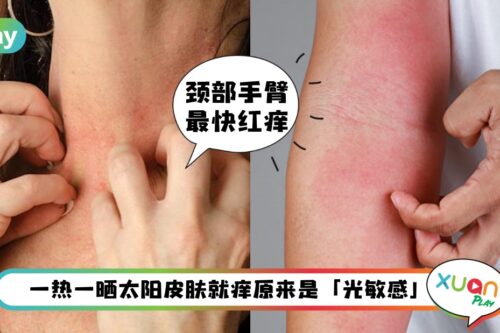 Tips I 晒一晒皮肤就发痒起红疹？你是中了紫外线过敏啊！