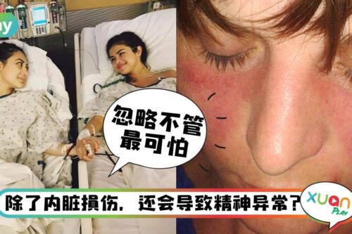 健康I 患病的90%都是年轻女性！红斑狼疮到底有多可怕？