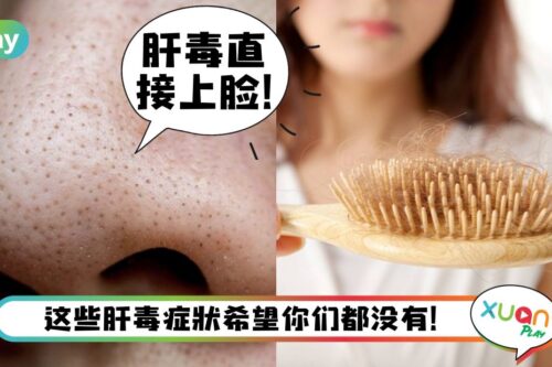 健康I 粉刺爆发、手掌现红斑，这4个症状一出现可要抓紧排肝毒！
