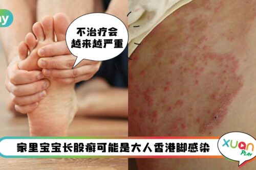 Tips I 大庭广众都不敢脱鞋？5招有效预防“香港脚”