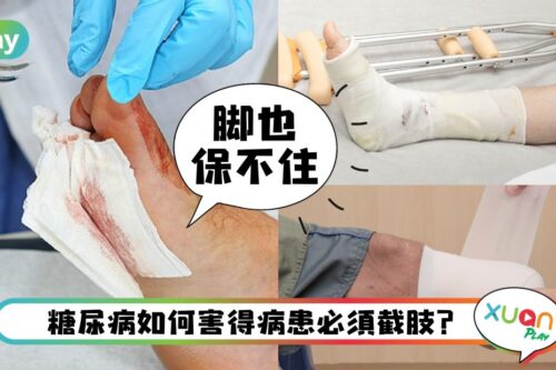 健康 I“拓也哥”患糖尿截肢保命仍然不治，糖尿病一定得截肢？