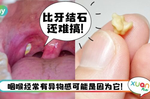 Tips I 口臭的祸首！小小白色的扁桃体结石到底是什么？