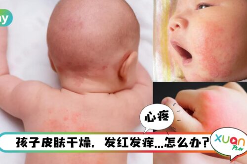 生活 | 【切勿轻信偏方】孩子一直抓痒,爸妈竟然用尿来止痒?!