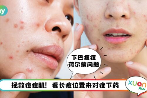 Tips I 脸上9个区域长痘时，教你针对性改善方法！