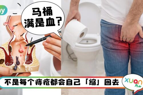 健康 I 痔疮不治不行吗?情况二度以上就得割?