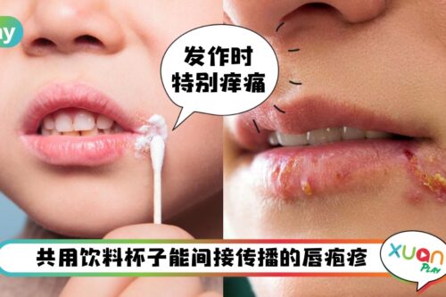 Tips I 动不动嘴边就长小水泡？预防唇疱疹你需要做好5件事