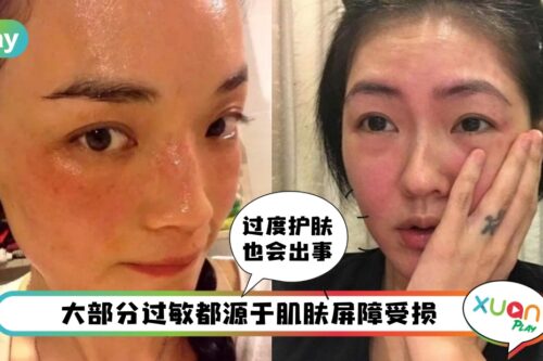 护肤 I 后天敏感肌从何而来？青春期清洁过度也受影响！