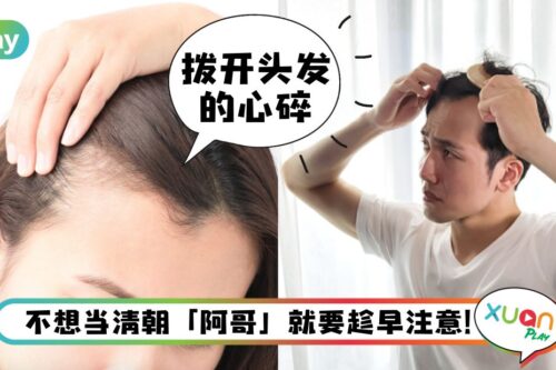 生活 I 发际线后移如何拯救？甜食、煎炸食物都是祸首？