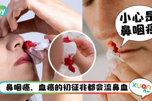 健康 I 流鼻血不该是常态！这5种原因都应该查清楚！