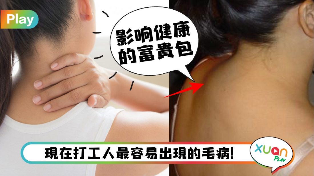 健康 I 竟越长越大，颈项后肿一块的“富贵包”到底是什么？
