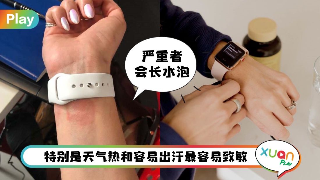 健康 I 戴智能手表出事的？导致接触性皮肤炎的3大原因
