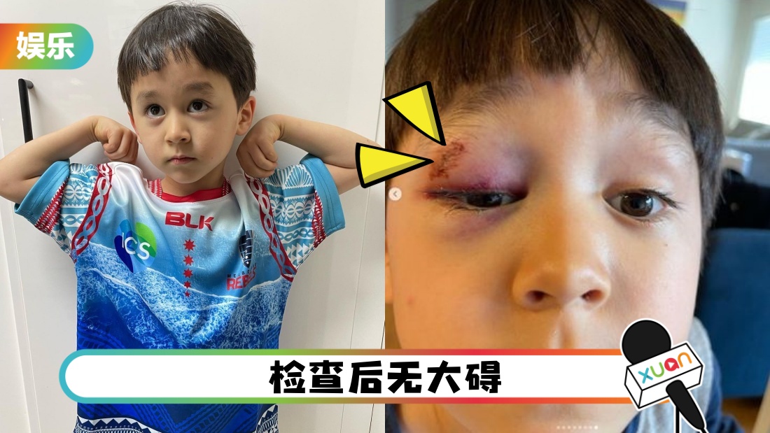 本特利右眼瘀青+肿胀！还原意外现场！