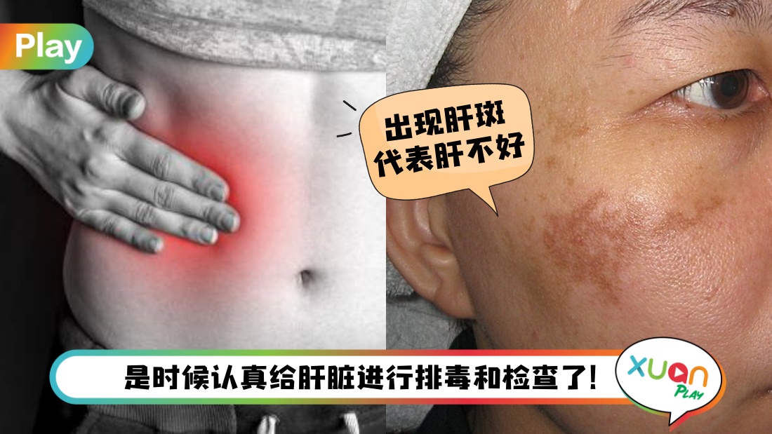 健康 I 无端端暴肥可能肝有事？肝受伤10个易见征兆