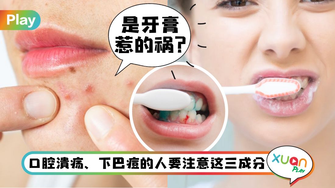Tips I 常烂嘴的人小心这成分！日日用的牙膏应该要小心选！