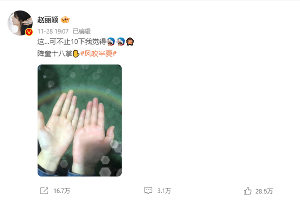 赵丽颖手肿