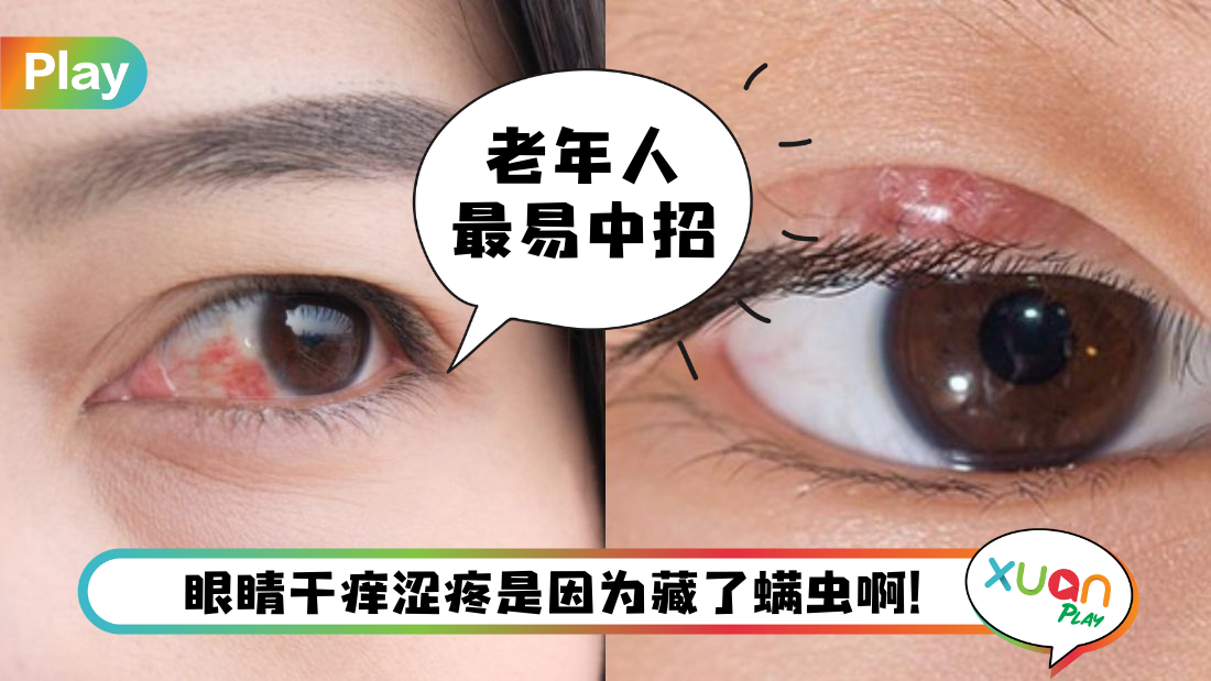 Tips I 眼睛经常干痒涩和有异物感？教你4个自测法眼里是否有螨虫！