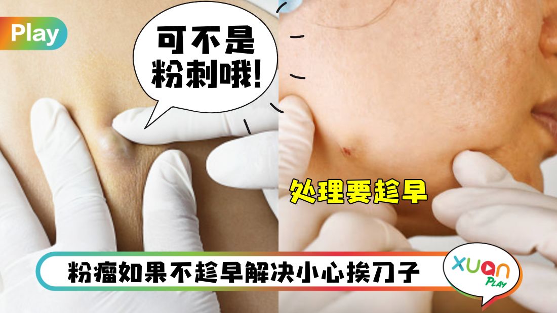 健康I 误会是超大颗暗疮，其实是粉瘤！严重还需要动手术？