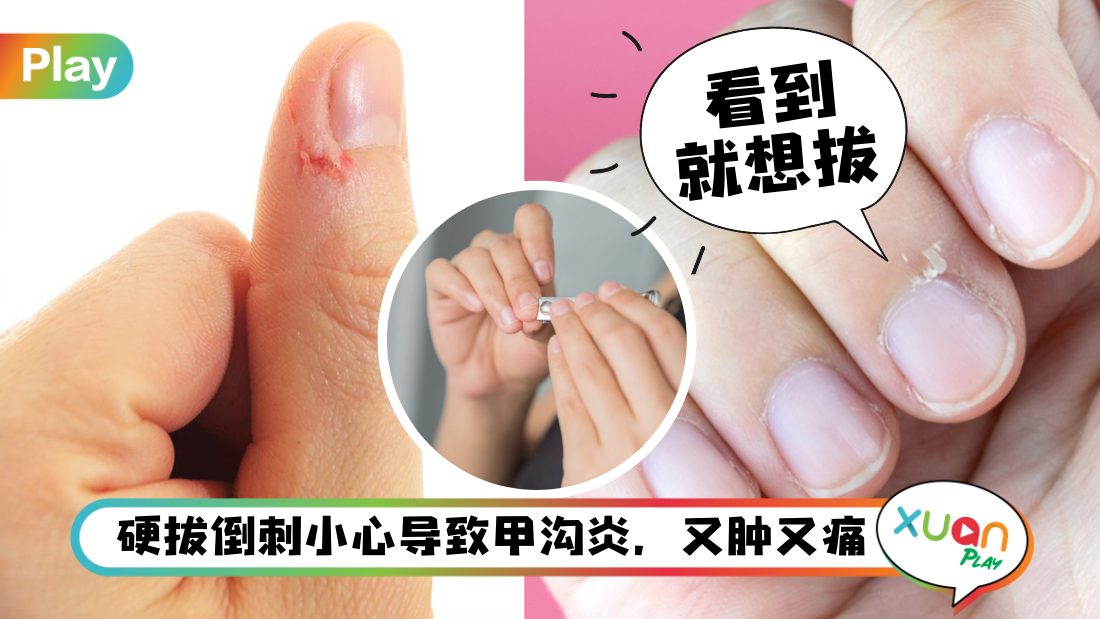 健康I 手指边缘长倒刺、脱皮不是因为干燥，竟和营养不良有关？