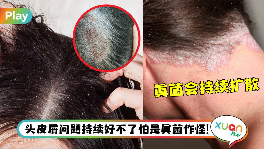 生活 I 头皮屑像雪花那么多？原来是头皮真菌感染在作怪！