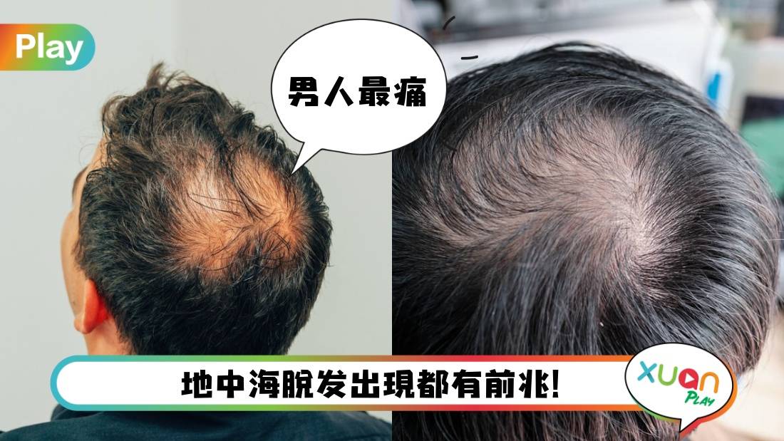 食谱 I 中医力荐健脾补肾养发汤,尤其适合地中海脱发问题!