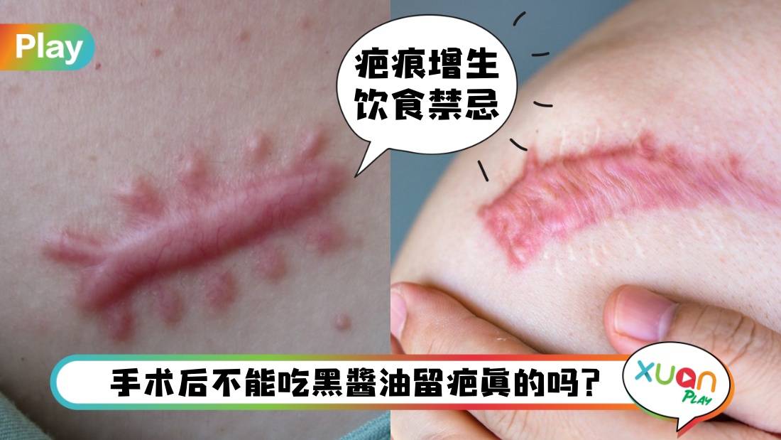 健康 I 手术后预防疤痕增生发炎，饮食5禁忌须知！