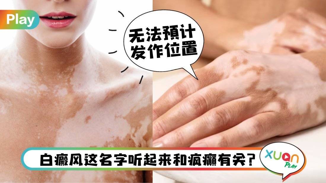 健康I 皮肤白斑好不了、头上突然一撮白发？小心是被白癜风找上你！