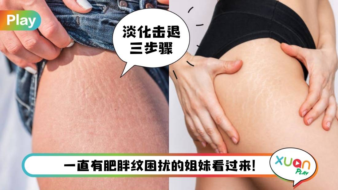 Tips I KO肥胖纹3大有效方法！网民实测效果肉眼可见