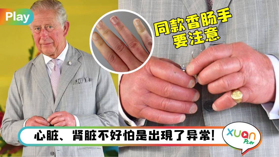 健康I 英王查尔斯手指肿得像香肠，有同款手指的人别不当回事！