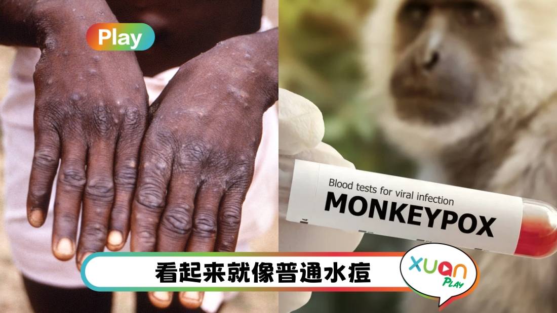 健康 | 卫生部加强检测！5方法预防感染“猴痘” 感染者需自行隔离