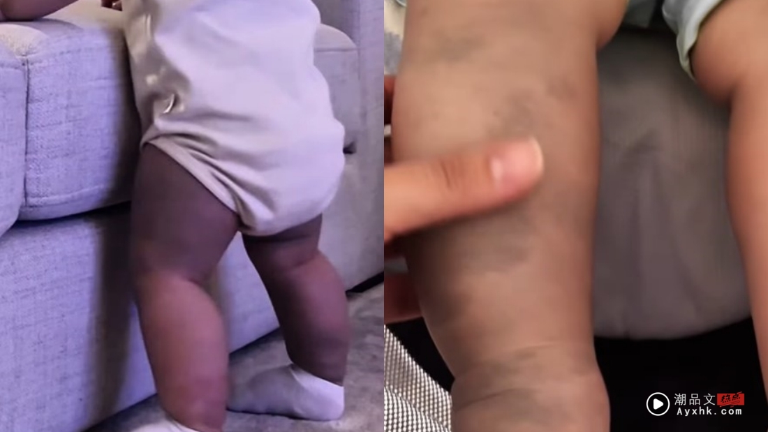 儿子脸部、全身都是胎记！JE庞琂予真诚剖白：他的不完美是我最爱的一部分 娱乐资讯 图3张