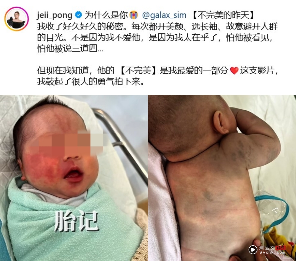 儿子脸部、全身都是胎记！JE庞琂予真诚剖白：他的不完美是我最爱的一部分 娱乐资讯 图2张