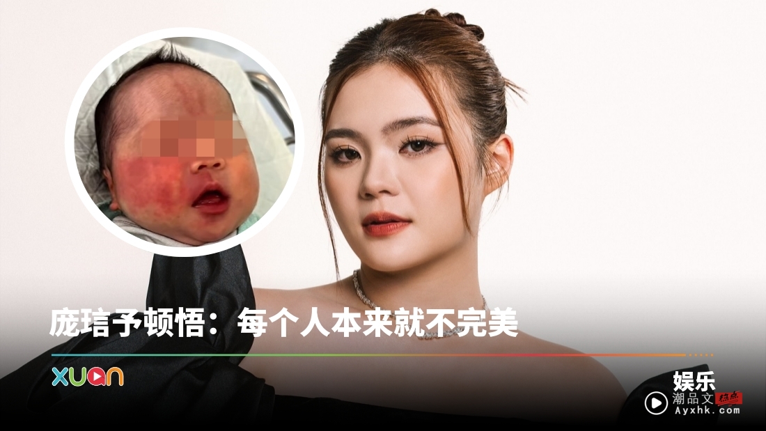 儿子脸部、全身都是胎记！JE庞琂予真诚剖白：他的不完美是我最爱的一部分