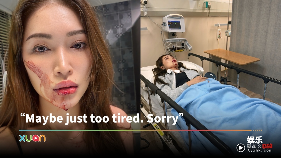 Amber Chia 疑疲劳过度晕倒!跌伤下巴入院动手术!