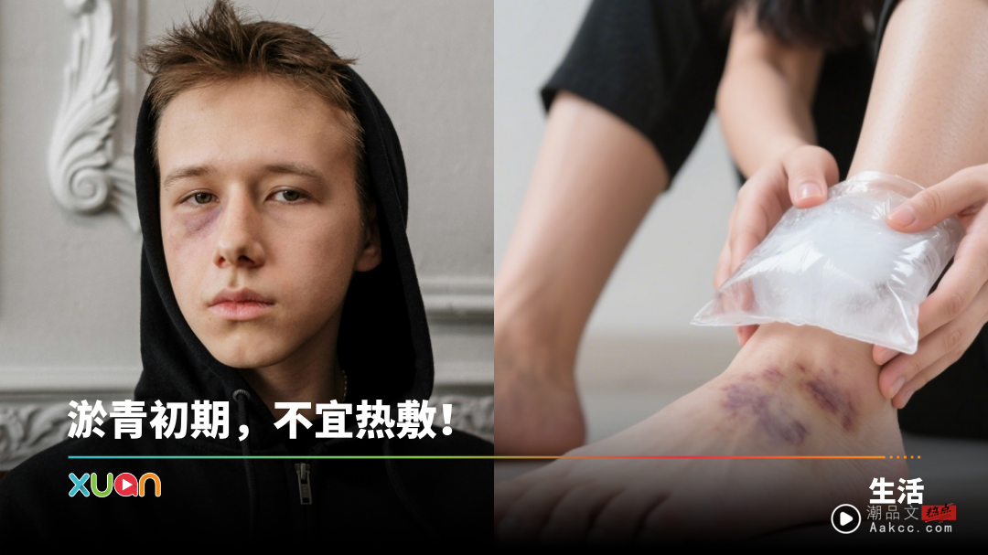 相关信息 | 淤青千万不要用力揉、揉鸡蛋！教你4招正确做法