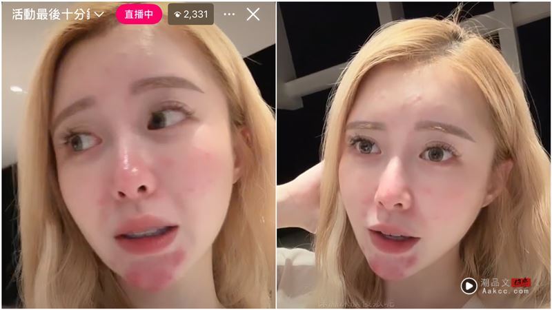 馒头妈震撼认怀四宝117天!公开烂脸真实面貌 被问“孩子的爸”回应了 内容图1 潮品文-大潮社旗下实时最新热点娱乐时尚数码等新闻资讯网站! 馒头妈因怀孕烂脸。(图/翻摄自IG)