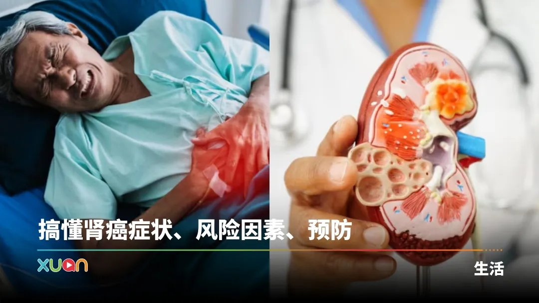 相关信息 | 许绍雄肾癌病逝！患病初期很难发现    6大风险因素