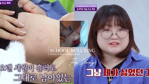 《黑暗荣耀》电卷棒受害者再现身！遭烫五分钟至二度灼伤，加害者现在竟是“护理师”！