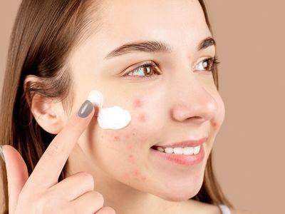 痘痘一直长好烦！皮肤科医师：手机、发品都是致命关键