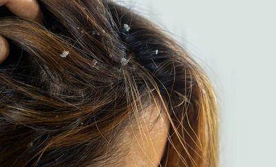 夏季出油、头皮屑有解！“好好洗头、做好清洁”最重要