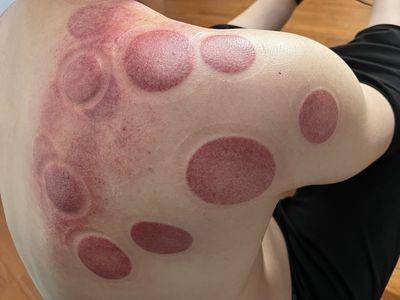 拔罐、刮痧减轻疲劳还能顺便瘦身！解决便秘、胀气代谢更快