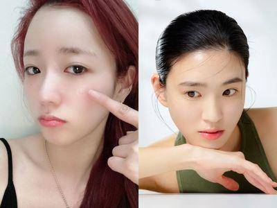 皮肤科医师教“正确挤痘法”不留痘印！　挤的方向很重要